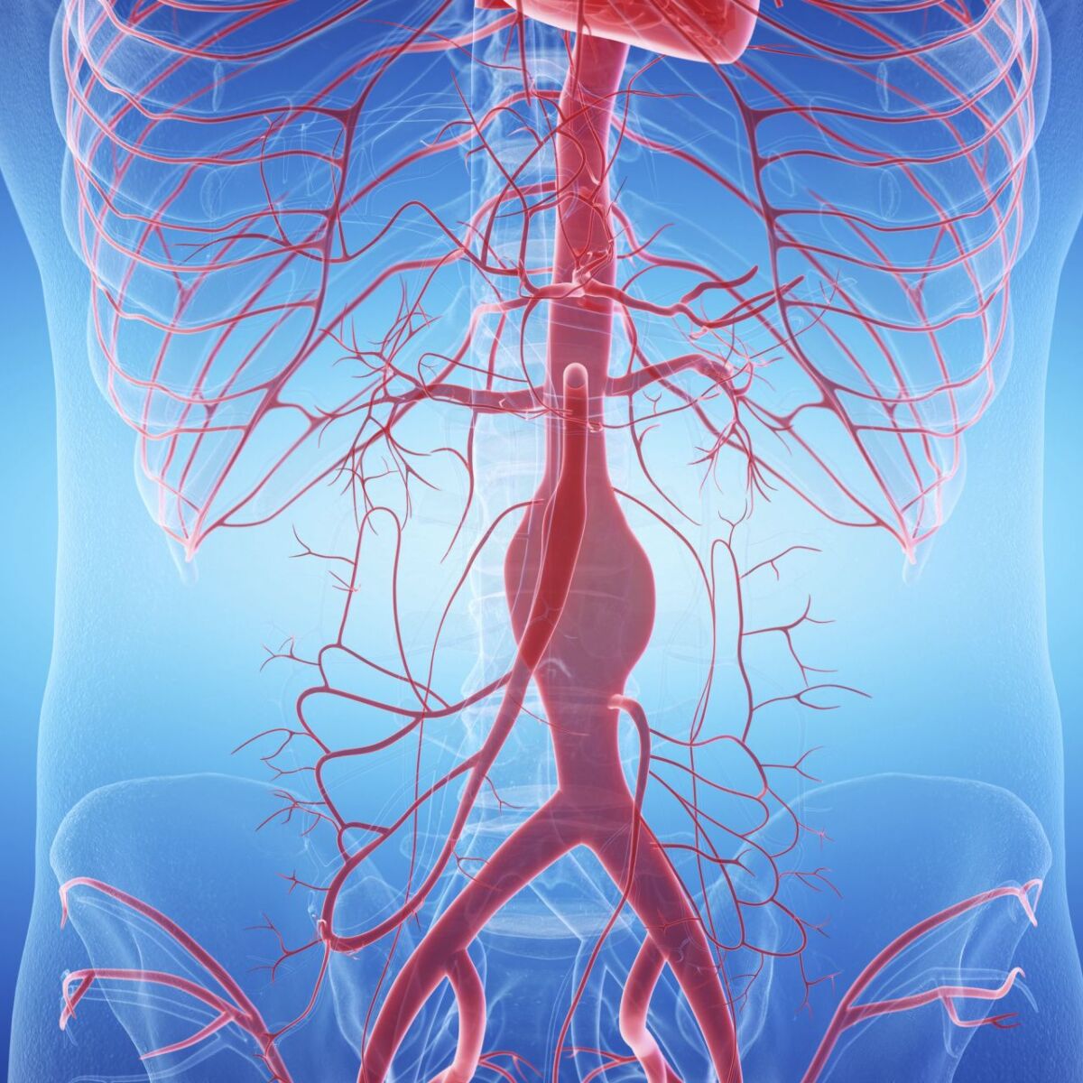 Illustration der Arterien im Körper mit Fokus auf eine aufgeblähte Arterie - Aneurysma