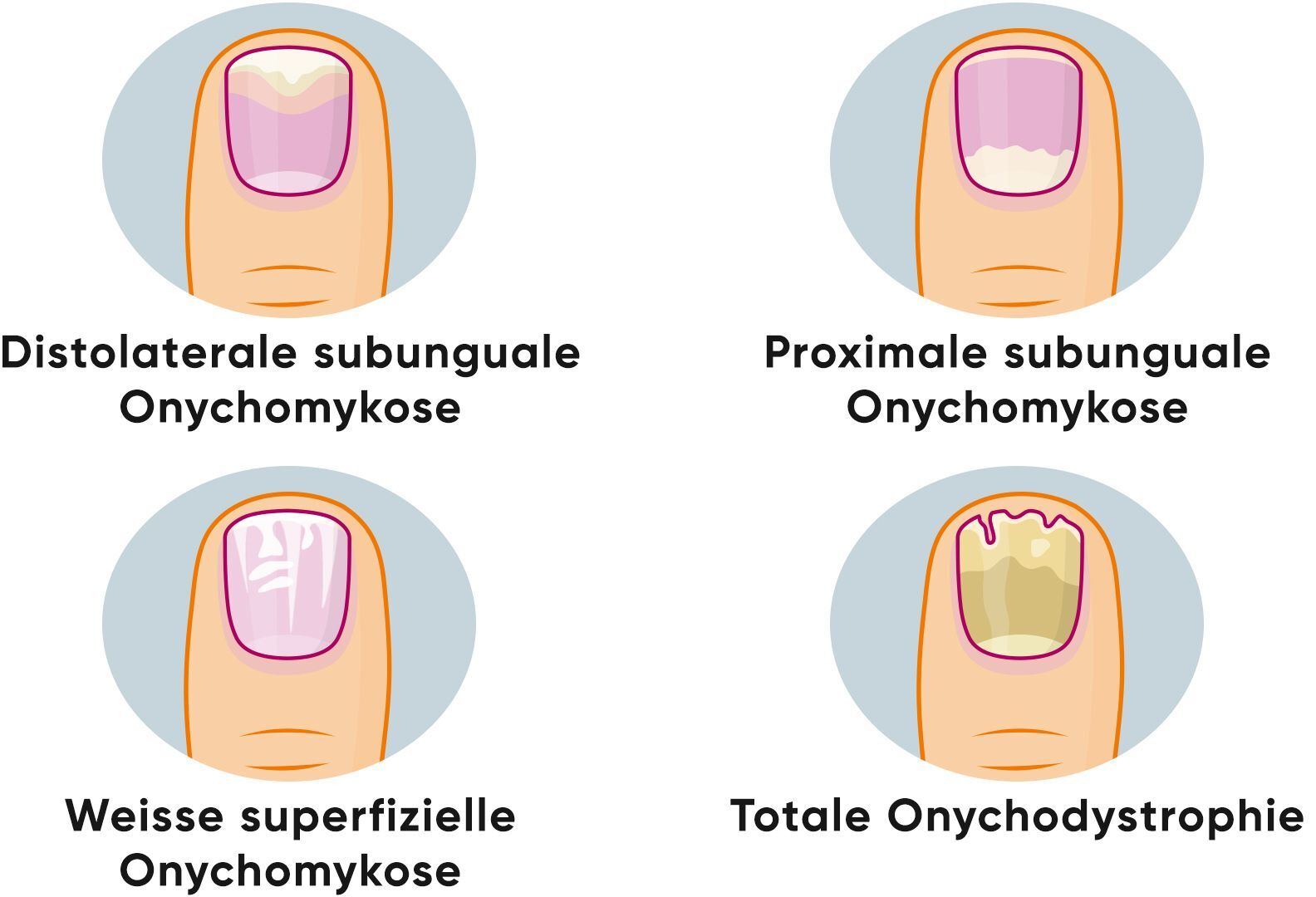 Nagelpilz - Fachleute unterscheiden drei verschiedene Formen der Onychomykose.