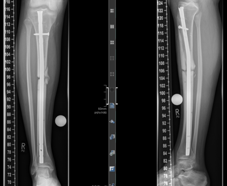 Pseudarthrosen (ausbleibende Knochenbruchheilung) Therapie ...