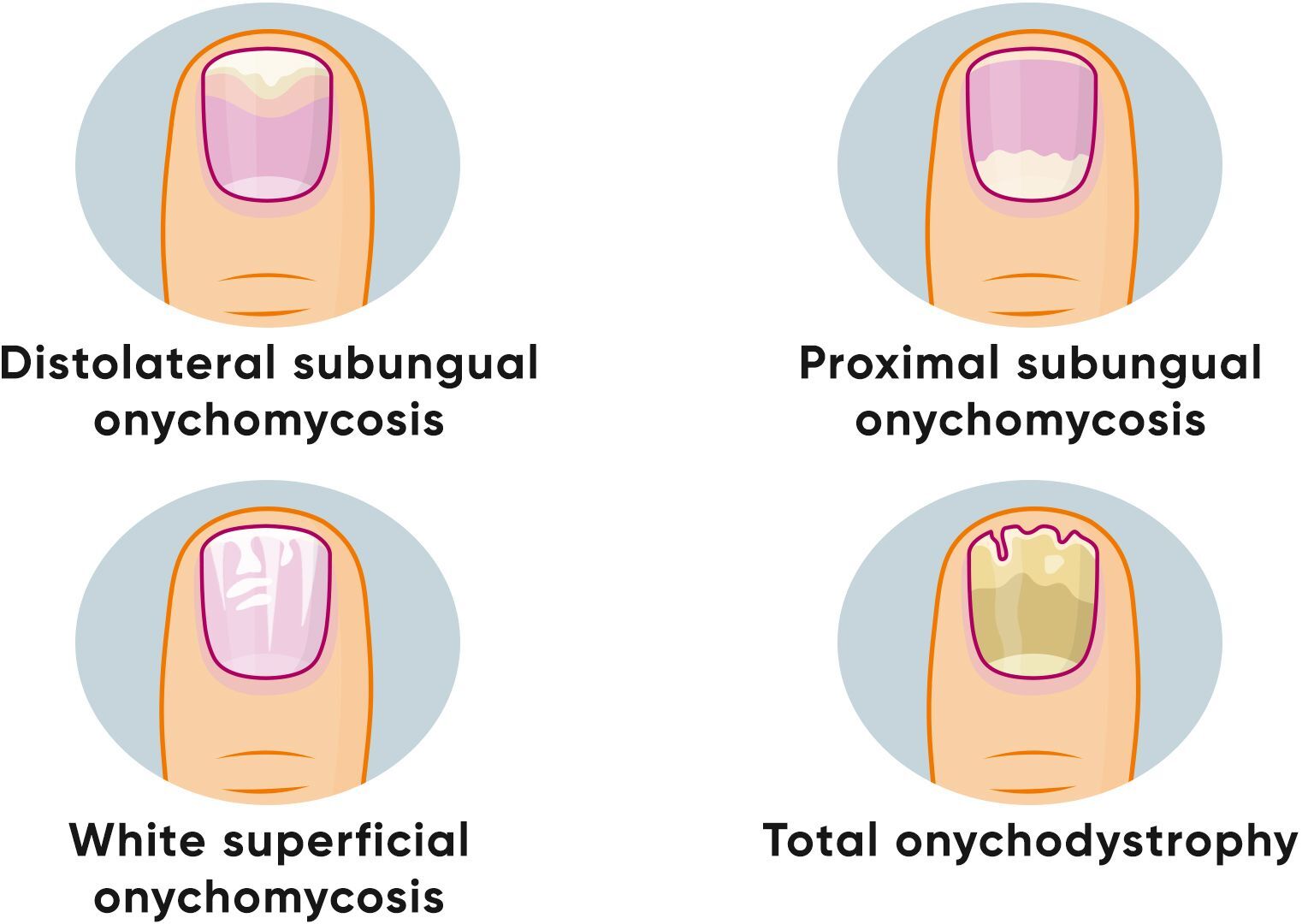 Nail fungus – experts distinguish between three different forms of onychomycosis.