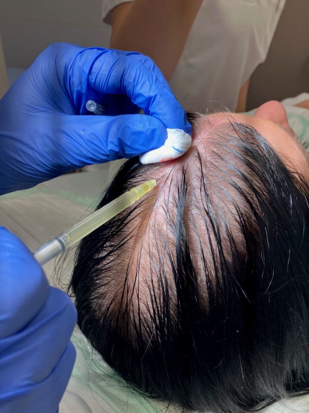 PRP treatment for a patient with hair loss