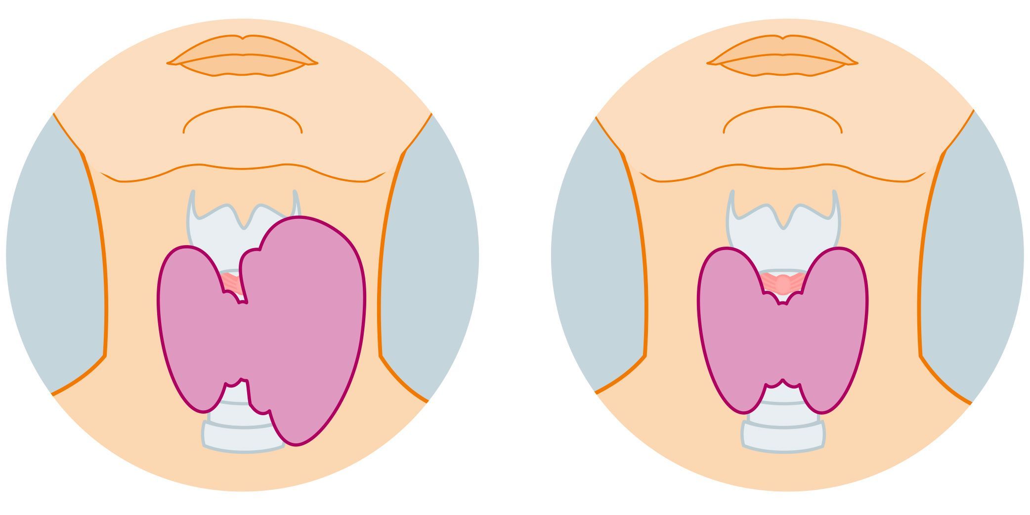 Illustration einer vergrösserten und einer gesunden Schilddrüse