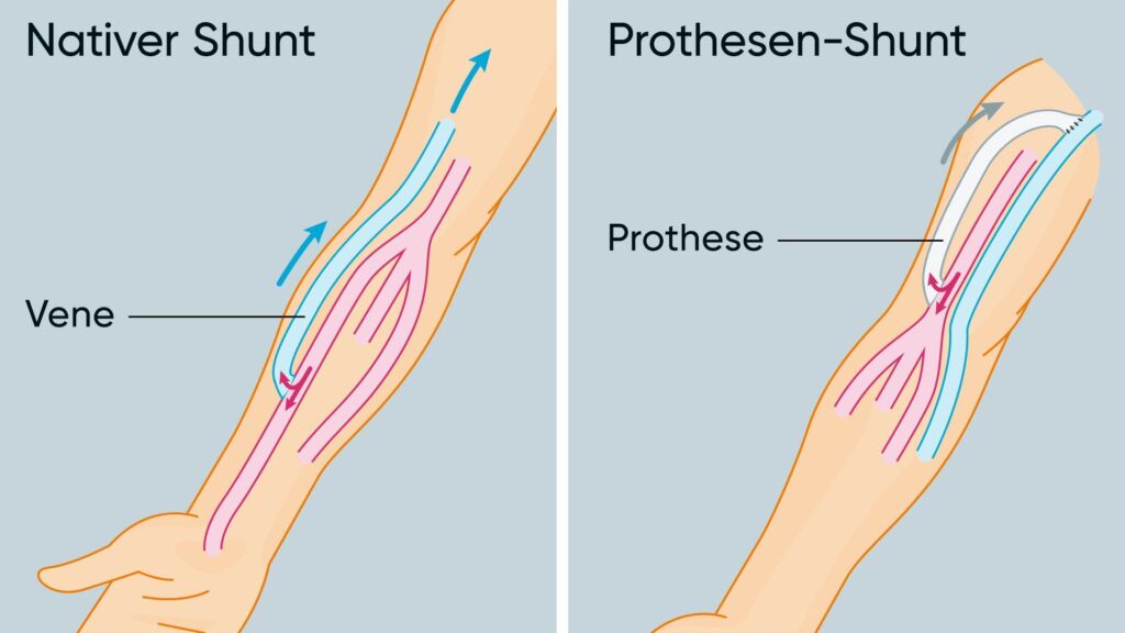 Illustration von einem nativen und Prothese-Shunt