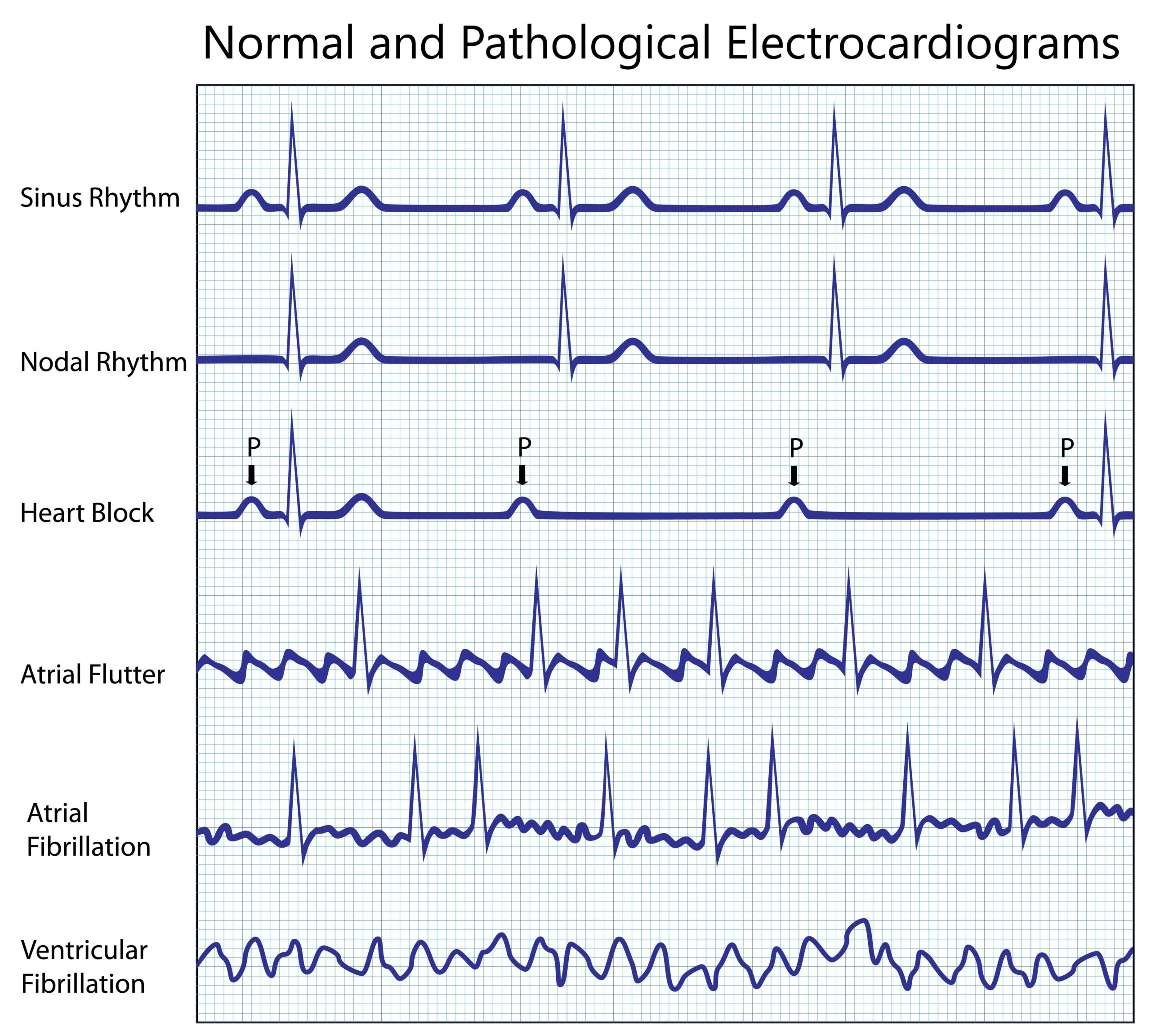 Illustration EKG normal und pathologisch