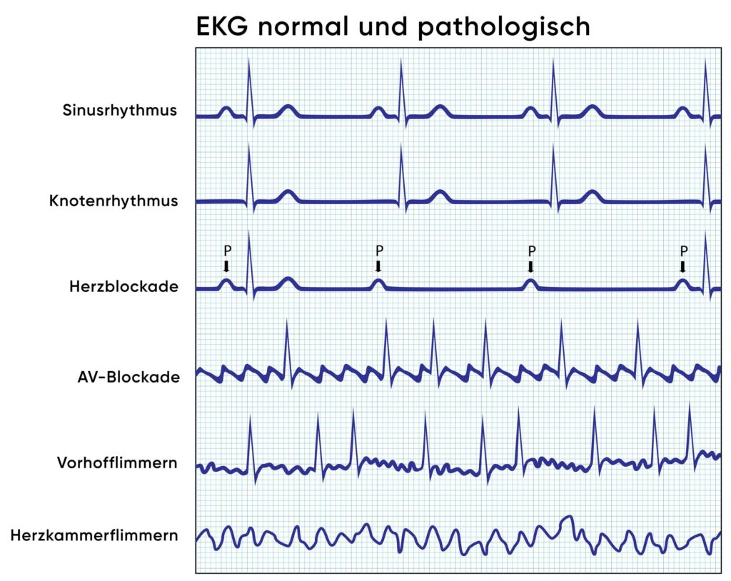 Illustration EKG normal und pathologisch