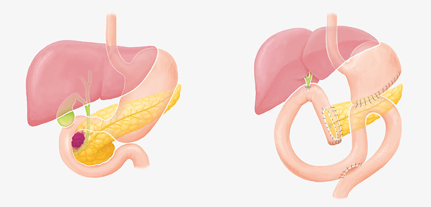 Illustration Pankreastumor Whipple Operation