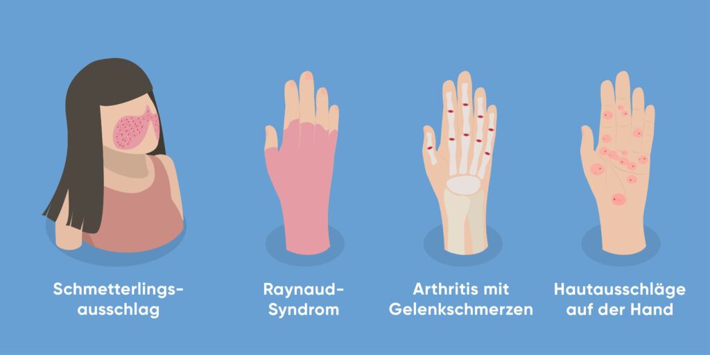 Illustration mit Syndromen bei Lupus